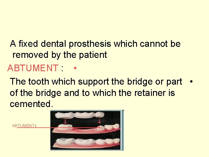 A fixed dental prosthesis which cannot be removed by the patient ABTUMENT : •