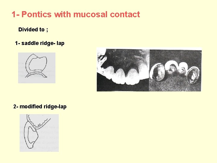 1 - Pontics with mucosal contact Divided to ; 1 - saddle ridge- lap