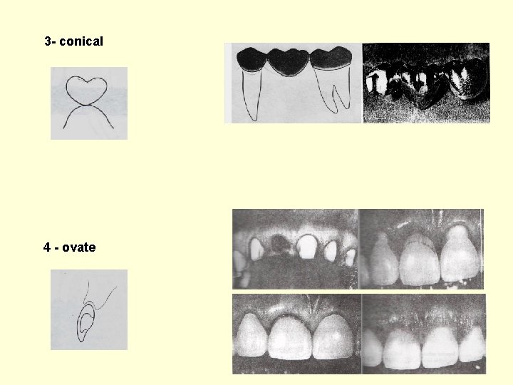 3 - conical 4 - ovate 