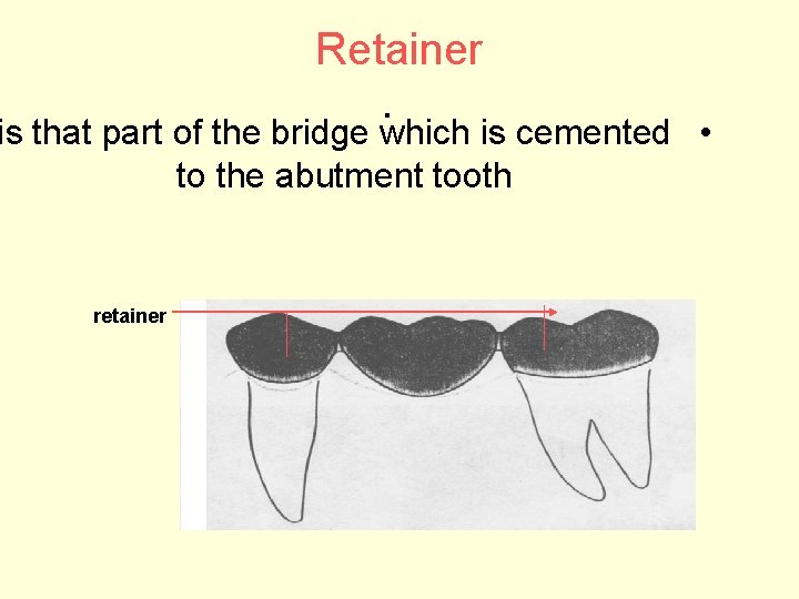Retainer. is that part of the bridge which is cemented • to the abutment