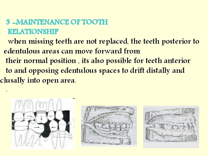 3 -MAINTENANCE OF TOOTH RELATIONSHIP when missing teeth are not replaced, the teeth posterior