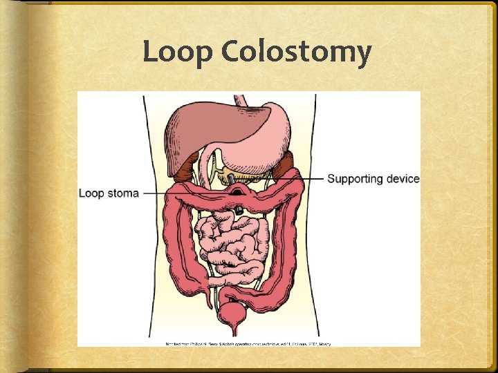 Loop Colostomy 