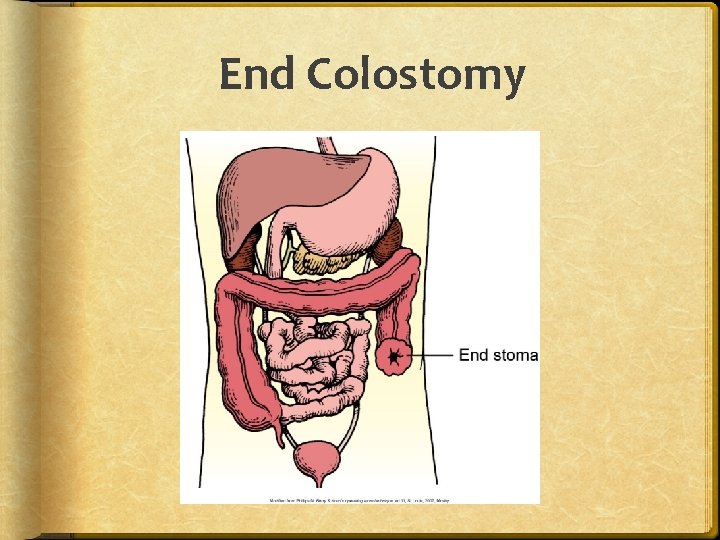 End Colostomy 
