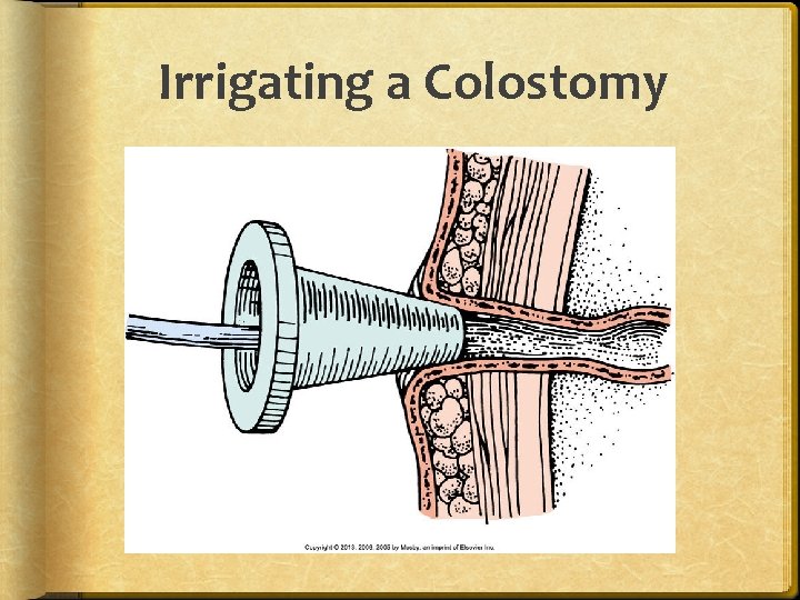 Irrigating a Colostomy 