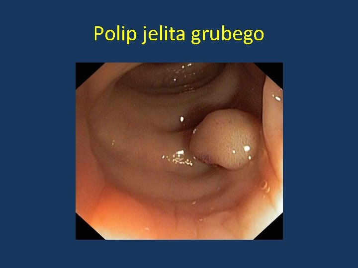Polip jelita grubego 