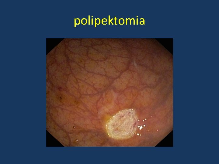 polipektomia 