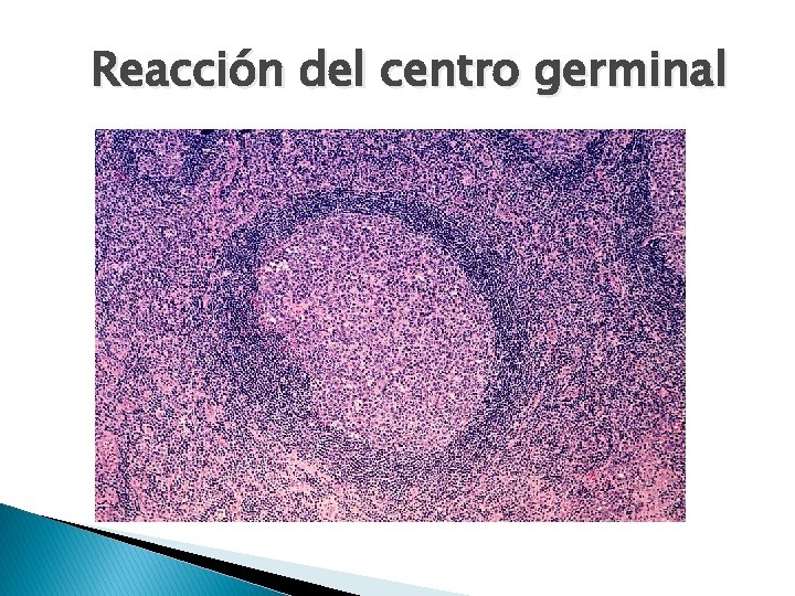Reacción del centro germinal 