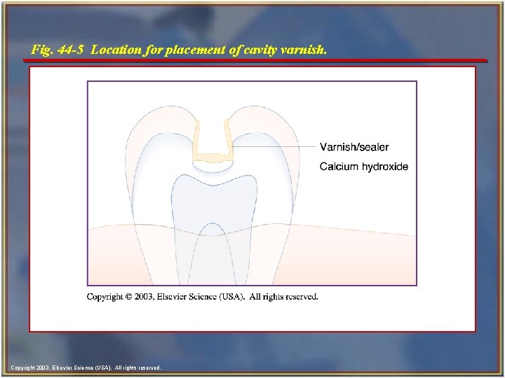 Fig. 44 -5 Location for placement of cavity varnish. Copyright 2003, Elsevier Science (USA). Fig. 44 -5 Location for placement of cavity varnish. Copyright 2003, Elsevier Science (USA).