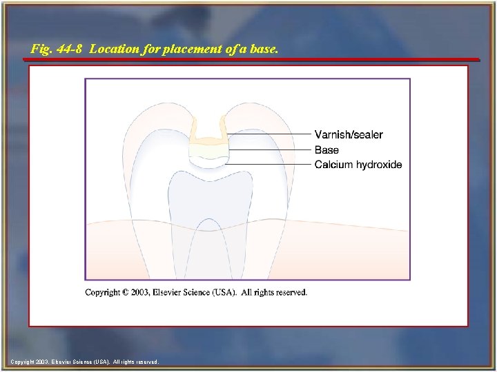 Fig. 44 -8 Location for placement of a base. Copyright 2003, Elsevier Science (USA). Fig. 44 -8 Location for placement of a base. Copyright 2003, Elsevier Science (USA).