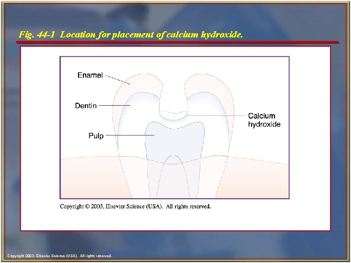 Fig. 44 -1 Location for placement of calcium hydroxide. Copyright 2003, Elsevier Science (USA). Fig. 44 -1 Location for placement of calcium hydroxide. Copyright 2003, Elsevier Science (USA).