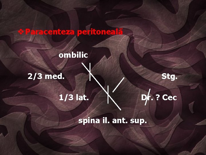 v Paracenteza peritoneală ombilic 2/3 med. Stg. 1/3 lat. Dr. ? Cec spina il.