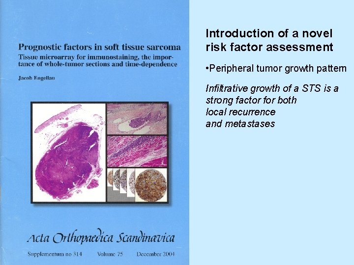 Introduction of a novel risk factor assessment • Peripheral tumor growth pattern Infiltrative growth