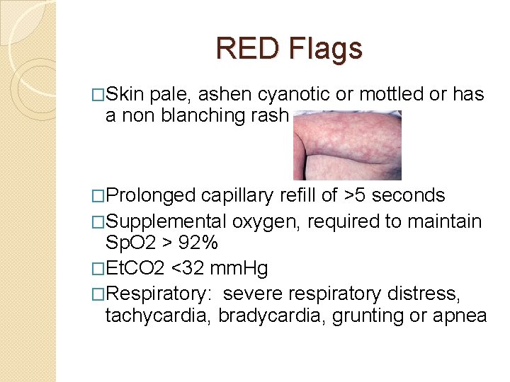 RED Flags �Skin pale, ashen cyanotic or mottled or has a non blanching rash