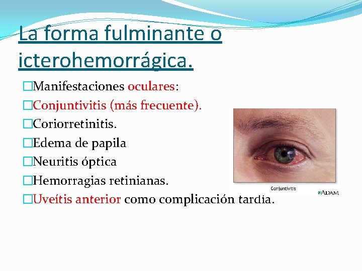 La forma fulminante o icterohemorrágica. �Manifestaciones oculares: �Conjuntivitis (más frecuente). �Coriorretinitis. �Edema de papila