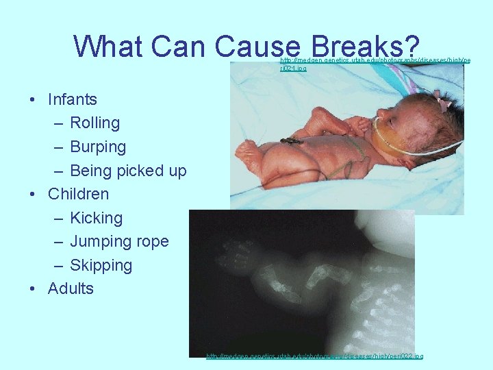 What Can Cause Breaks? http: //medgen. genetics. utah. edu/photographs/diseases/high/pe ri 021. jpg • Infants