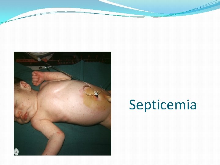 Septicemia 