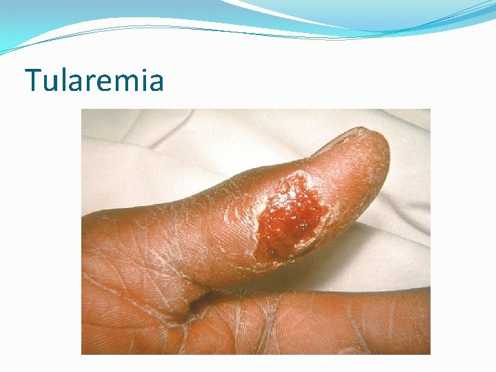 Tularemia 