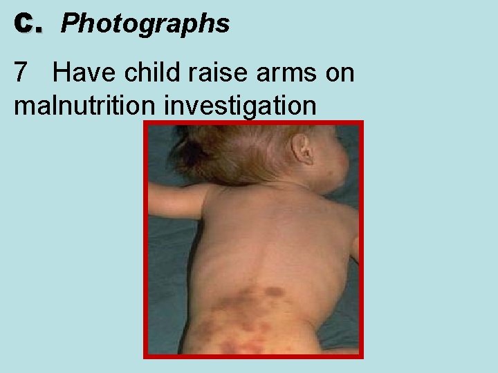 C. Photographs C. 7 Have child raise arms on malnutrition investigation 