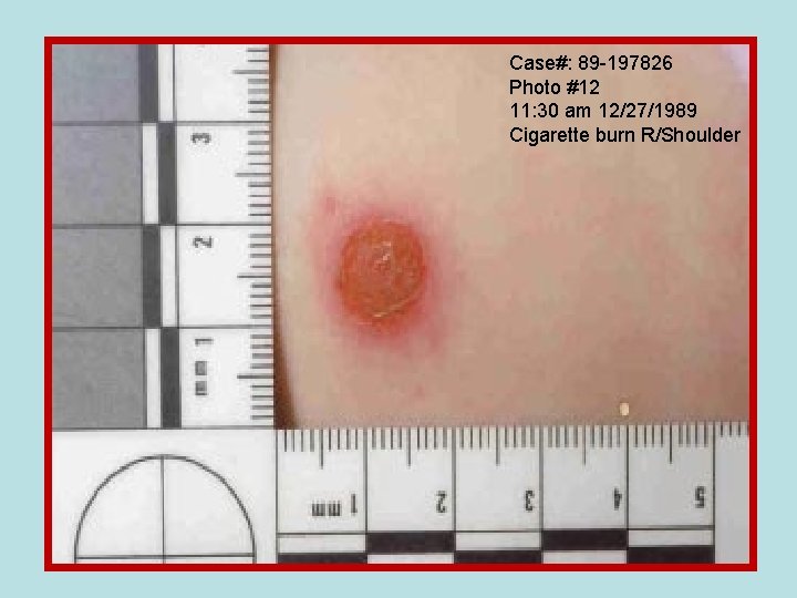 Case#: 89 -197826 Photo #12 11: 30 am 12/27/1989 Cigarette burn R/Shoulder 