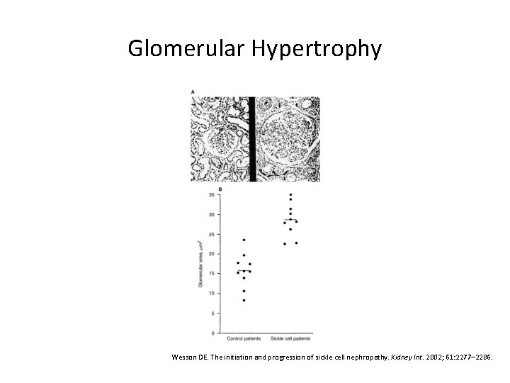 Glomerular Hypertrophy Wesson DE. The initiation and progression of sickle cell nephropathy. Kidney Int.