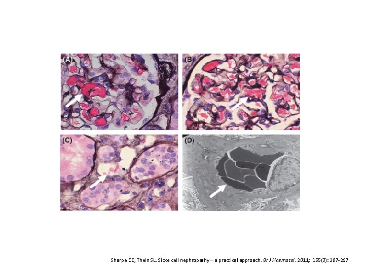 Sharpe CC, Thein SL. Sicke cell nephropathy – a practical approach. Br J Haematol.