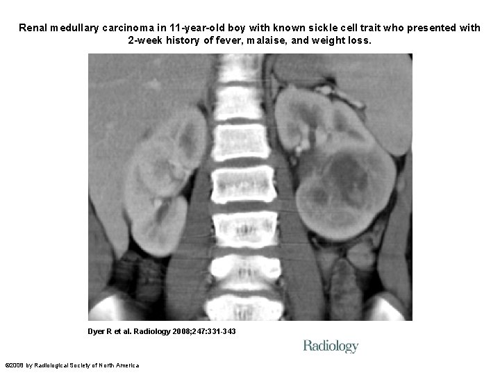 Renal medullary carcinoma in 11 -year-old boy with known sickle cell trait who presented