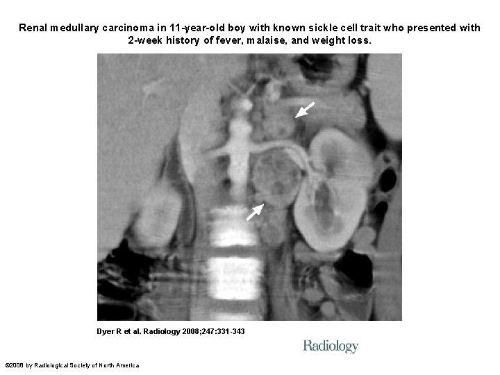 Renal medullary carcinoma in 11 -year-old boy with known sickle cell trait who presented