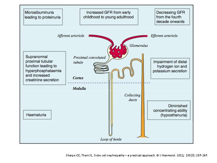 Sharpe CC, Thein SL. Sicke cell nephropathy – a practical approach. Br J Haematol.