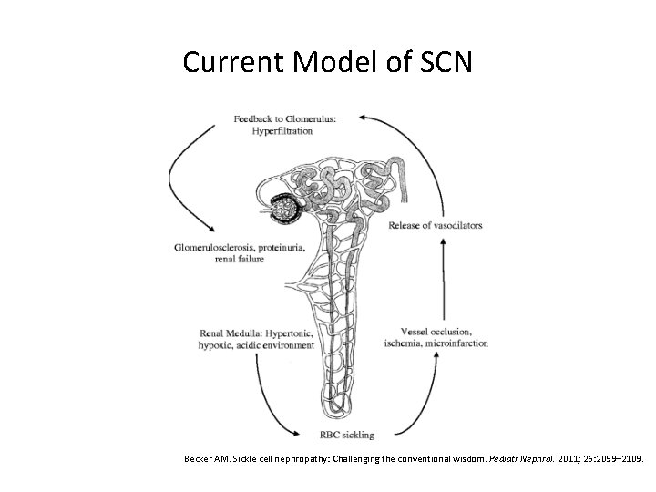 Current Model of SCN Becker AM. Sickle cell nephropathy: Challenging the conventional wisdom. Pediatr