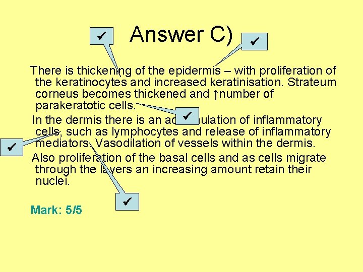  Answer C) There is thickening of the epidermis – with proliferation of the