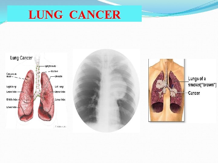 LUNG CANCER 