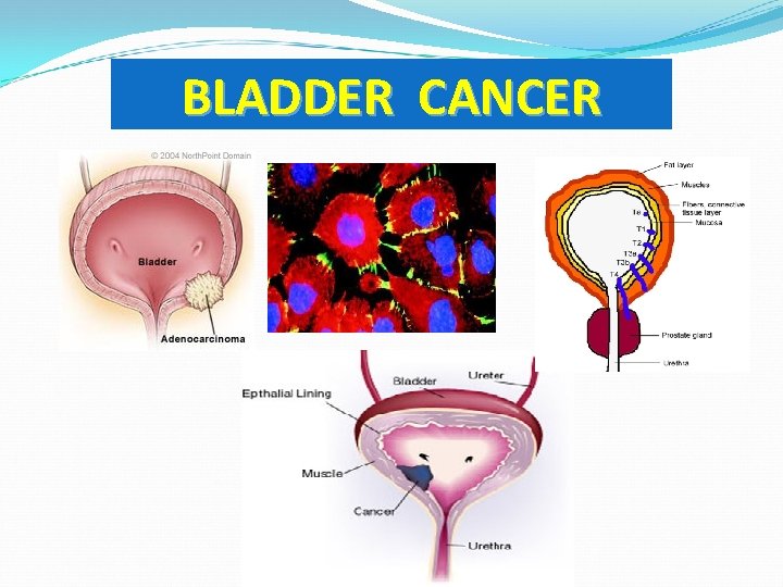 BLADDER CANCER 