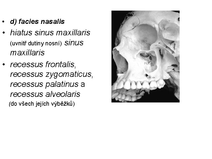  • d) facies nasalis • hiatus sinus maxillaris (uvnitř dutiny nosní) sinus maxillaris