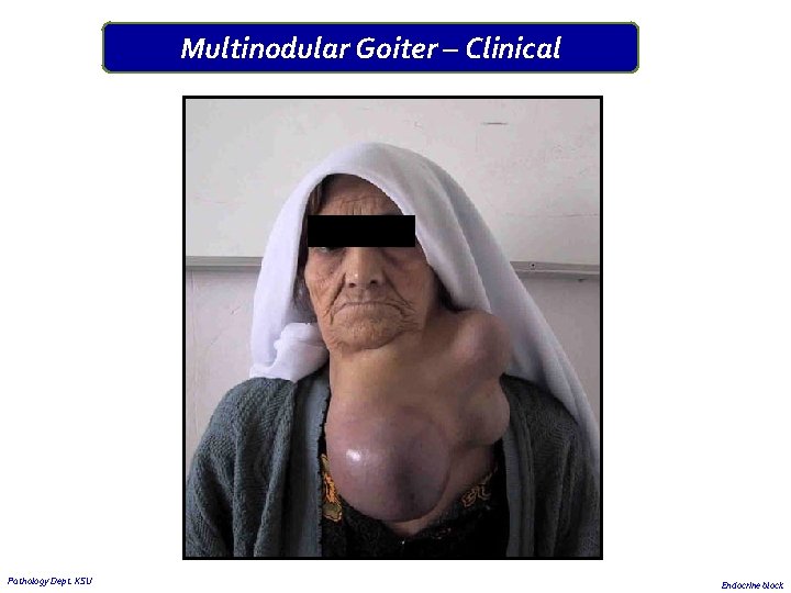 Multinodular Goiter – Clinical Pathology Dept. KSU Endocrine block 