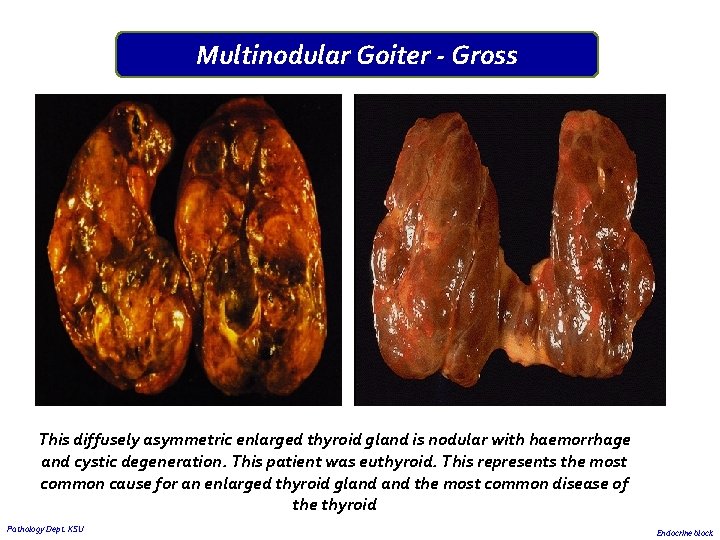 Multinodular Goiter - Gross This diffusely asymmetric enlarged thyroid gland is nodular with haemorrhage