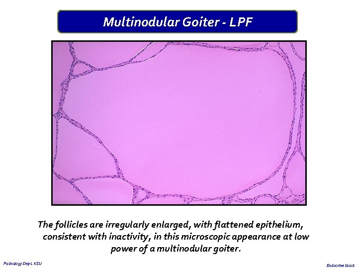 Multinodular Goiter - LPF The follicles are irregularly enlarged, with flattened epithelium, consistent with