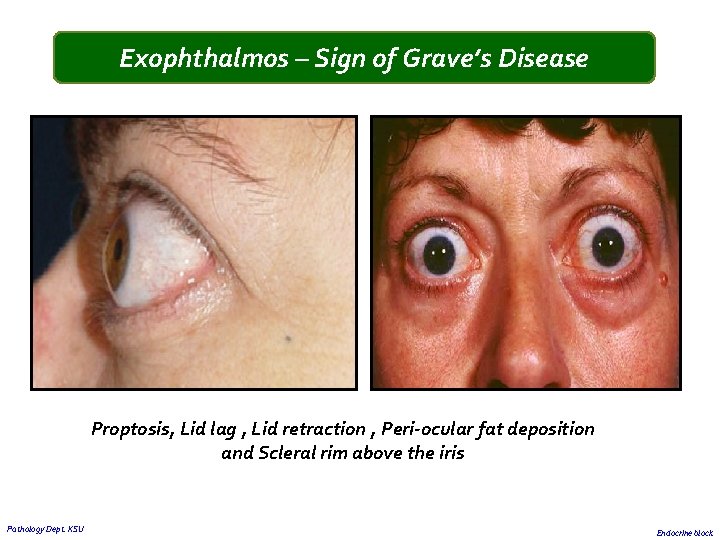 Exophthalmos – Sign of Grave’s Disease Proptosis, Lid lag , Lid retraction , Peri-ocular