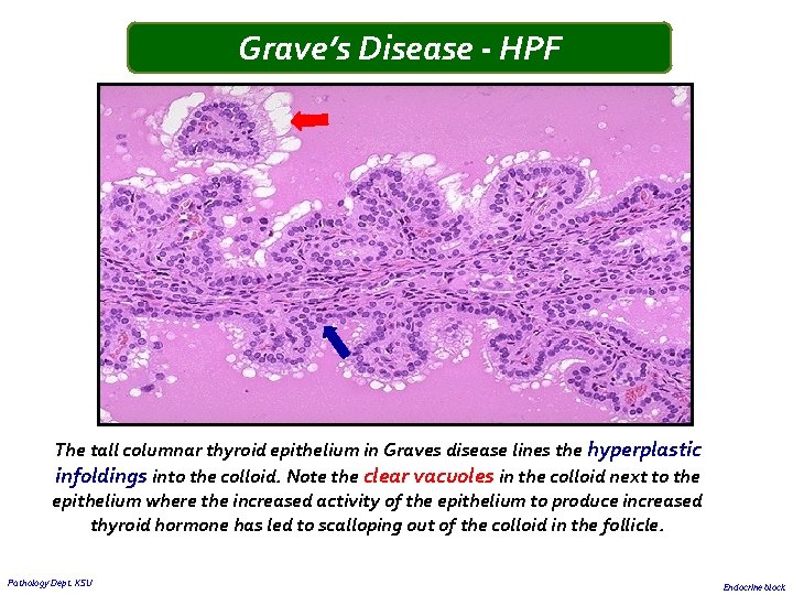 Grave’s Disease - HPF The tall columnar thyroid epithelium in Graves disease lines the