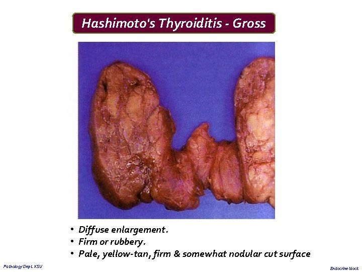 Hashimoto's Thyroiditis - Gross • Diffuse enlargement. • Firm or rubbery. • Pale, yellow-tan,