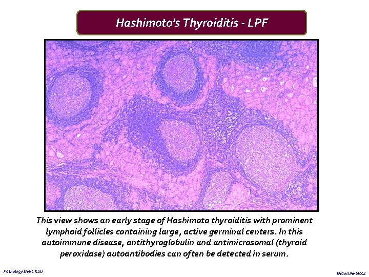 Hashimoto's Thyroiditis - LPF This view shows an early stage of Hashimoto thyroiditis with