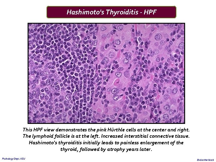 Hashimoto's Thyroiditis - HPF This HPF view demonstrates the pink Hürthle cells at the