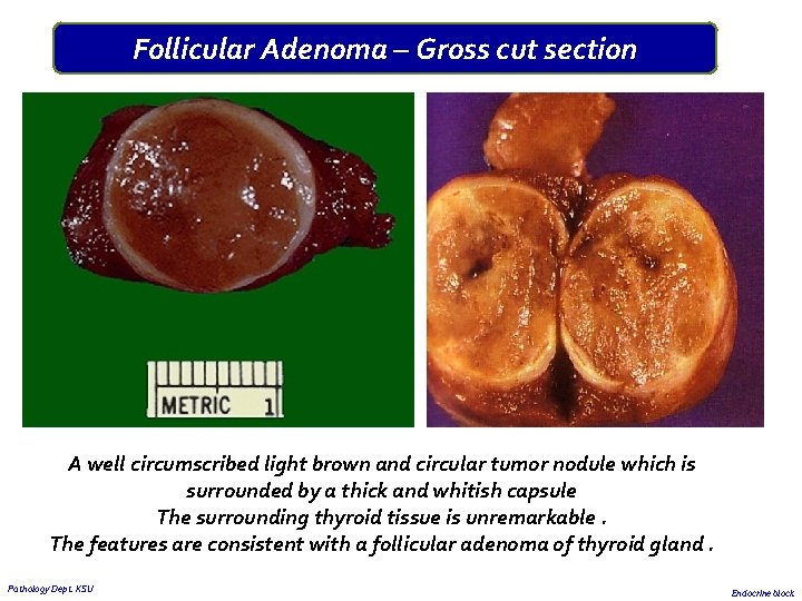 Follicular Adenoma – Gross cut section A well circumscribed light brown and circular tumor