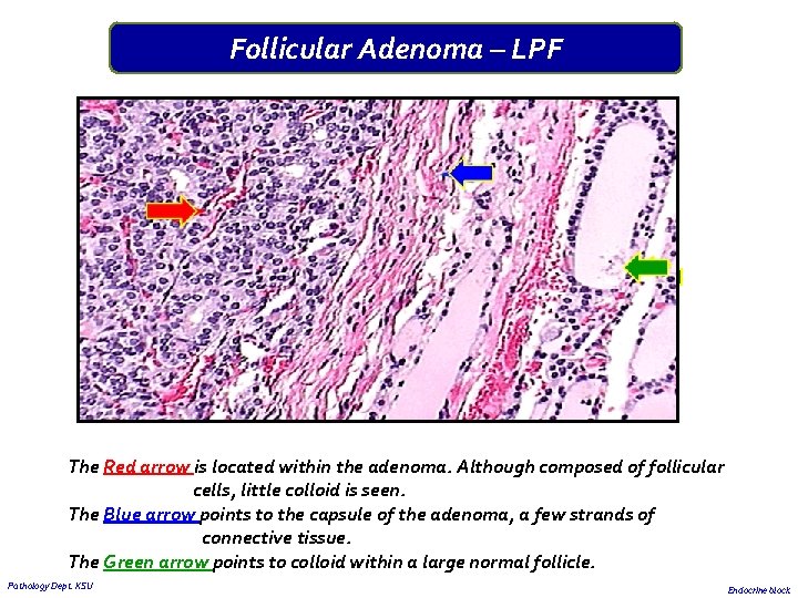 Follicular Adenoma – LPF The Red arrow is located within the adenoma. Although composed