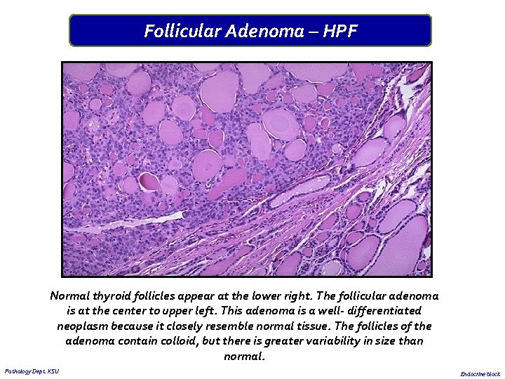 Follicular Adenoma – HPF Normal thyroid follicles appear at the lower right. The follicular