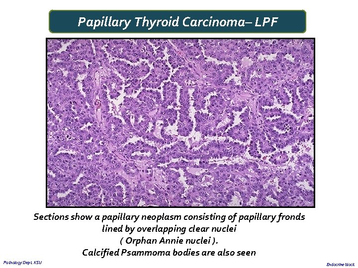 Papillary Thyroid Carcinoma– LPF Sections show a papillary neoplasm consisting of papillary fronds lined