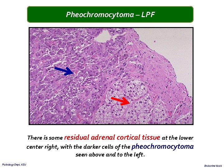 Pheochromocytoma – LPF There is some residual adrenal cortical tissue at the lower center