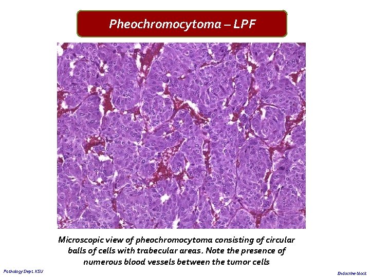 Pheochromocytoma – LPF Microscopic view of pheochromocytoma consisting of circular balls of cells with
