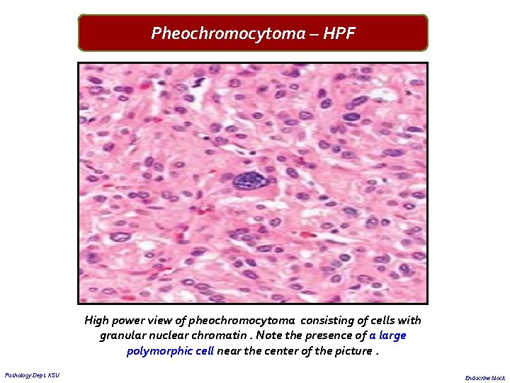 Pheochromocytoma – HPF High power view of pheochromocytoma consisting of cells with granular nuclear
