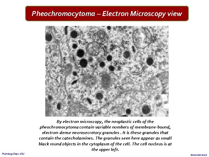 Pheochromocytoma – Electron Microscopy view Pathology Dept. KSU By electron microscopy, the neoplastic cells