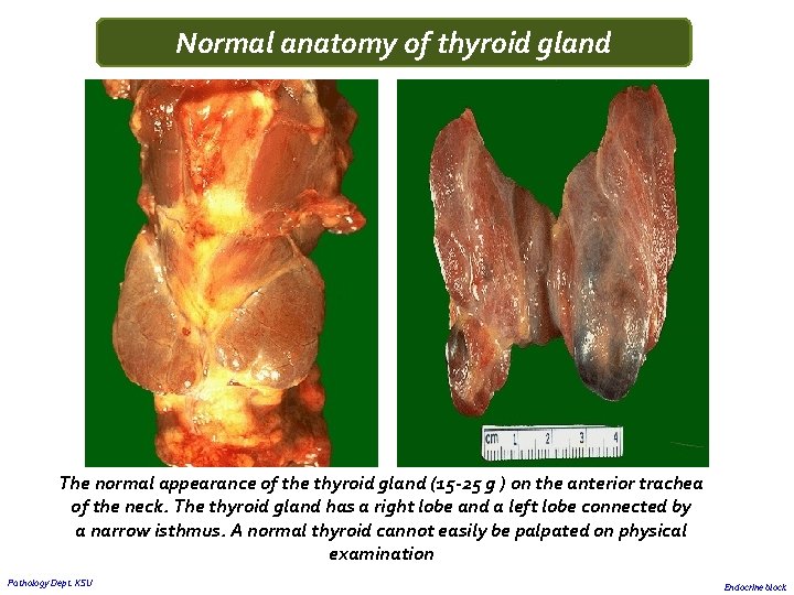 Normal anatomy of thyroid gland The normal appearance of the thyroid gland (15 -25